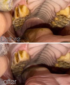 gingivitis